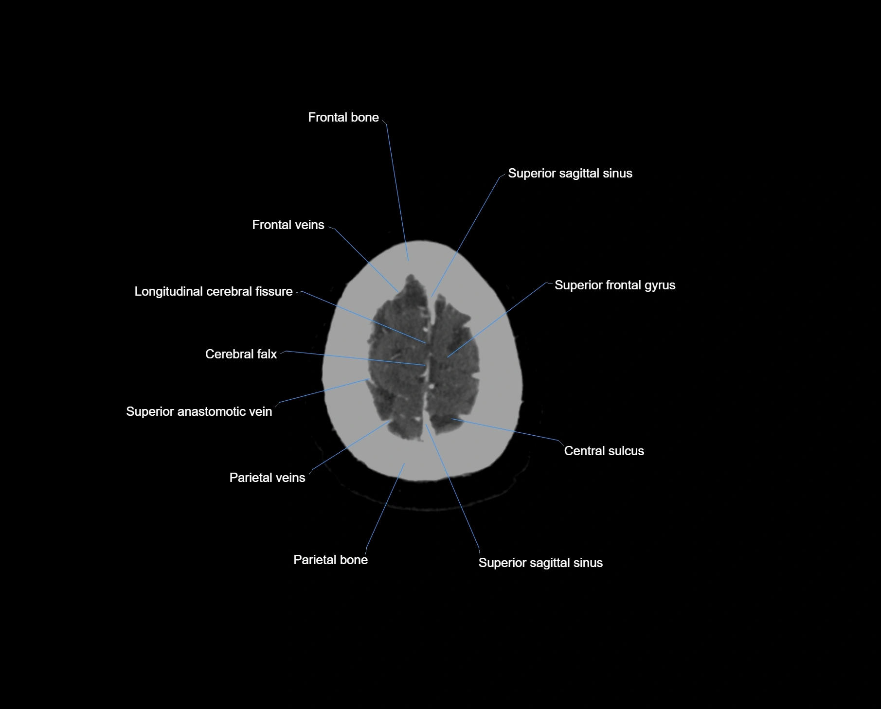 CT scan brain axial labelled cross sectional anatomy image-img-000068.webp